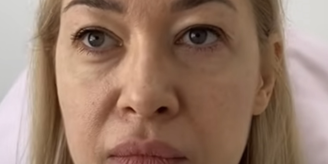 МЕЗОНИТИ ДО И ПОСЛЕ. Ставим нити COG, мгновенная подтяжка лица.