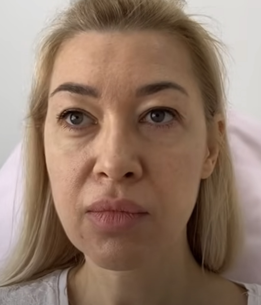 Фото до процедуры