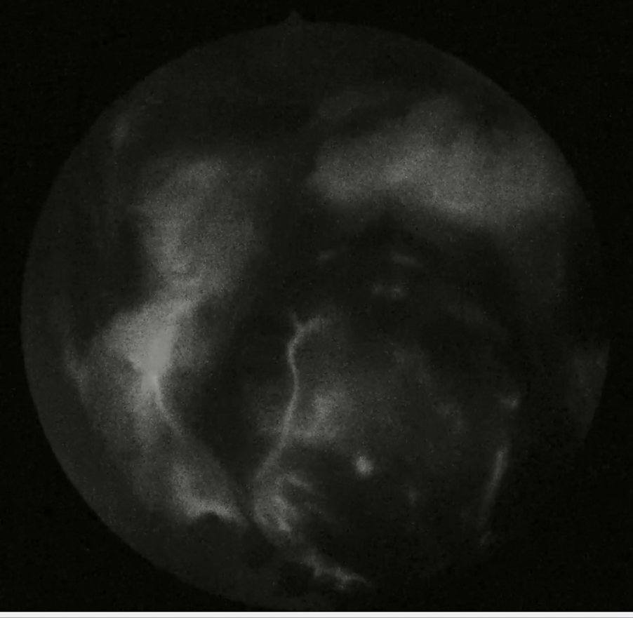 ICG-контрастирование сосудов аденомы гипофиза. Монохромный режим