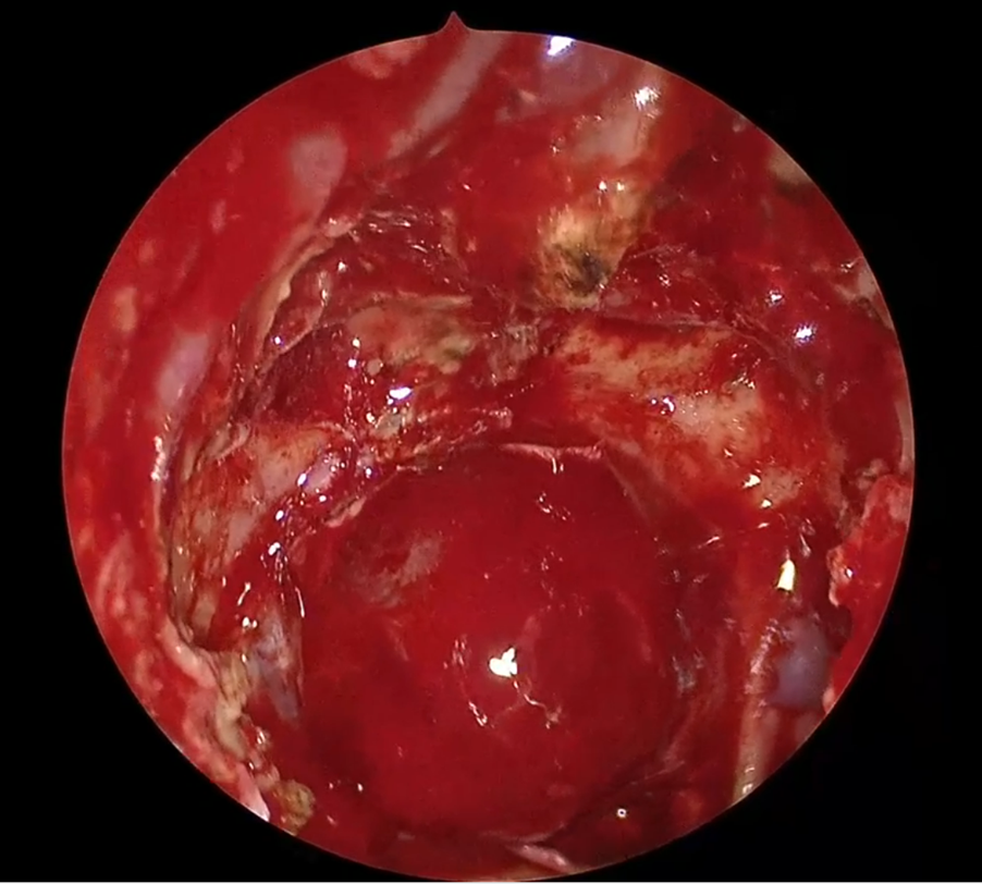 Выделенная аденома гипофиза в белом свете