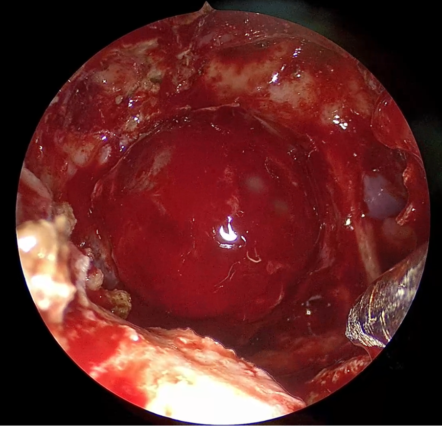 Выделенная аденома гипофиза в белом свете