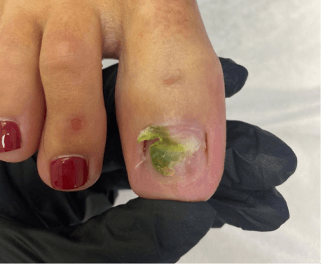 Синегнойная палочка на ногтях