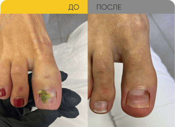 Восстановление ногтя с синегнойной палочкой с помощью ФДТ