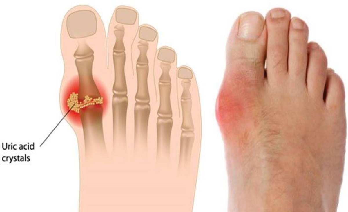 Слева показаны те самые кристаллы мочевой кислоты, они поврждеют ткани вокруг косточки.