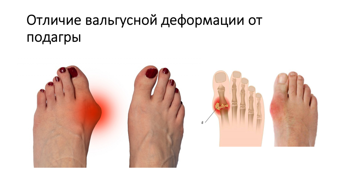 Слева - воспаленный вальгус, справа - та самапя подагра.