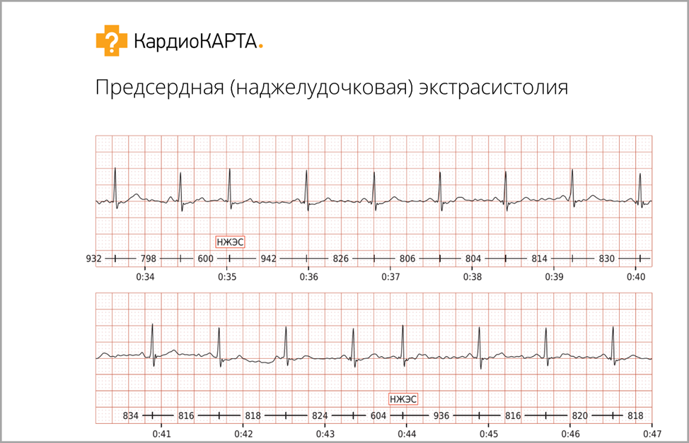 ЭКГ при наджелудочковой экстрасистолии КардиоКАРТА. 