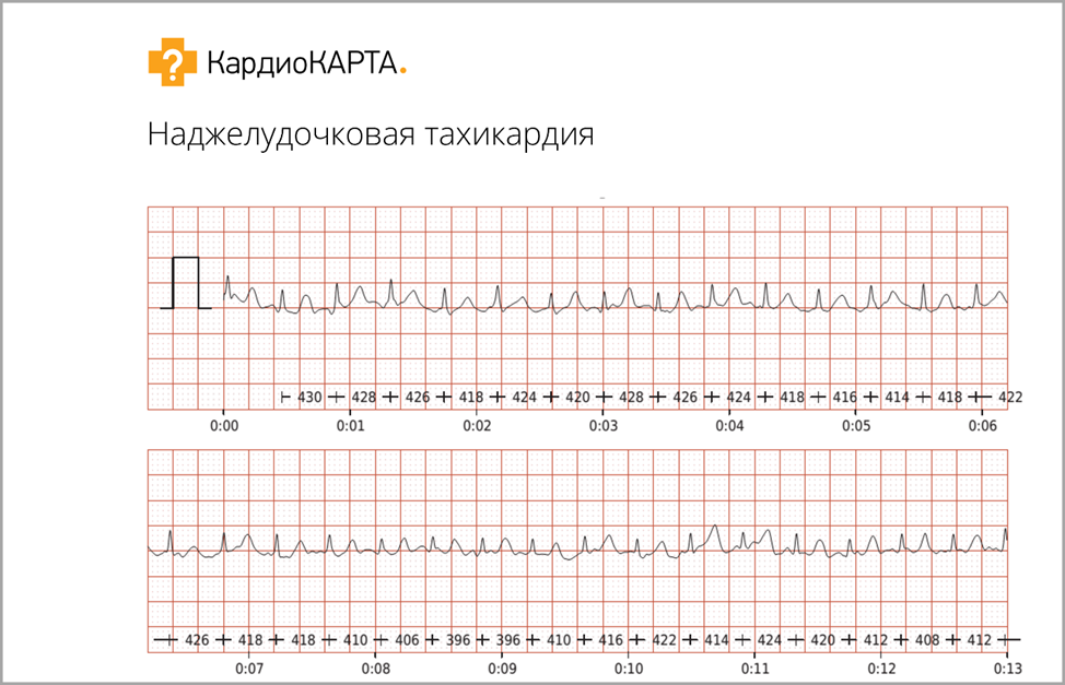 ЭКГ при наджелудочковой тахикардии. КардиоКАРТА.