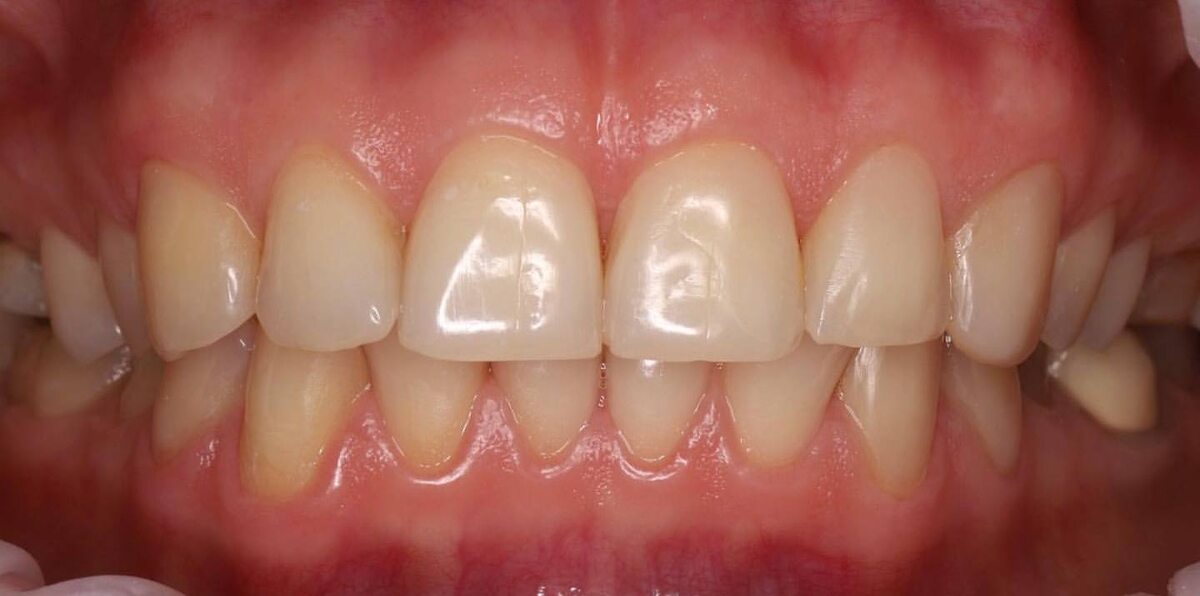 Фото нашего пациента: композитные виниры часто используют для устранения 
косметических дефектов нескольких передних единиц.