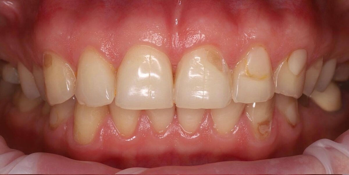 Фото нашего паицента до реставрации.