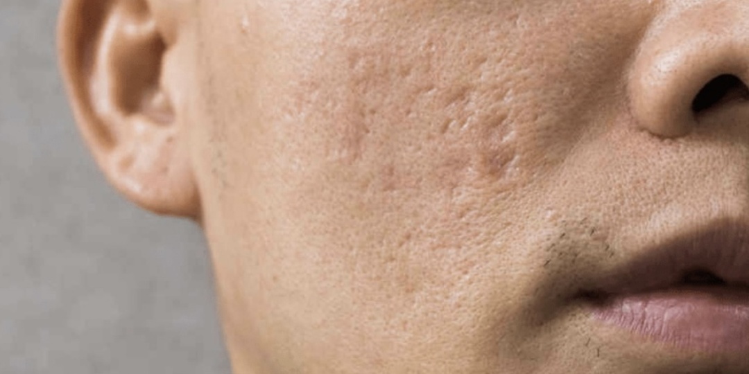 ПОСТАКНЕ: Самый правильный и эффективный способ. Как избавиться?