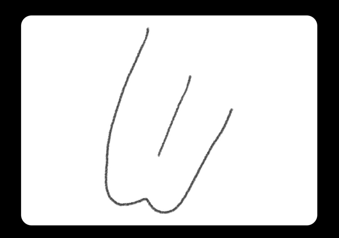 Так выглядит язык с укороченной уздечкой при вытягивании вперёд из полости рта