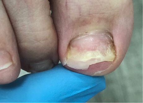 Ноготь после ожога гель-лаком