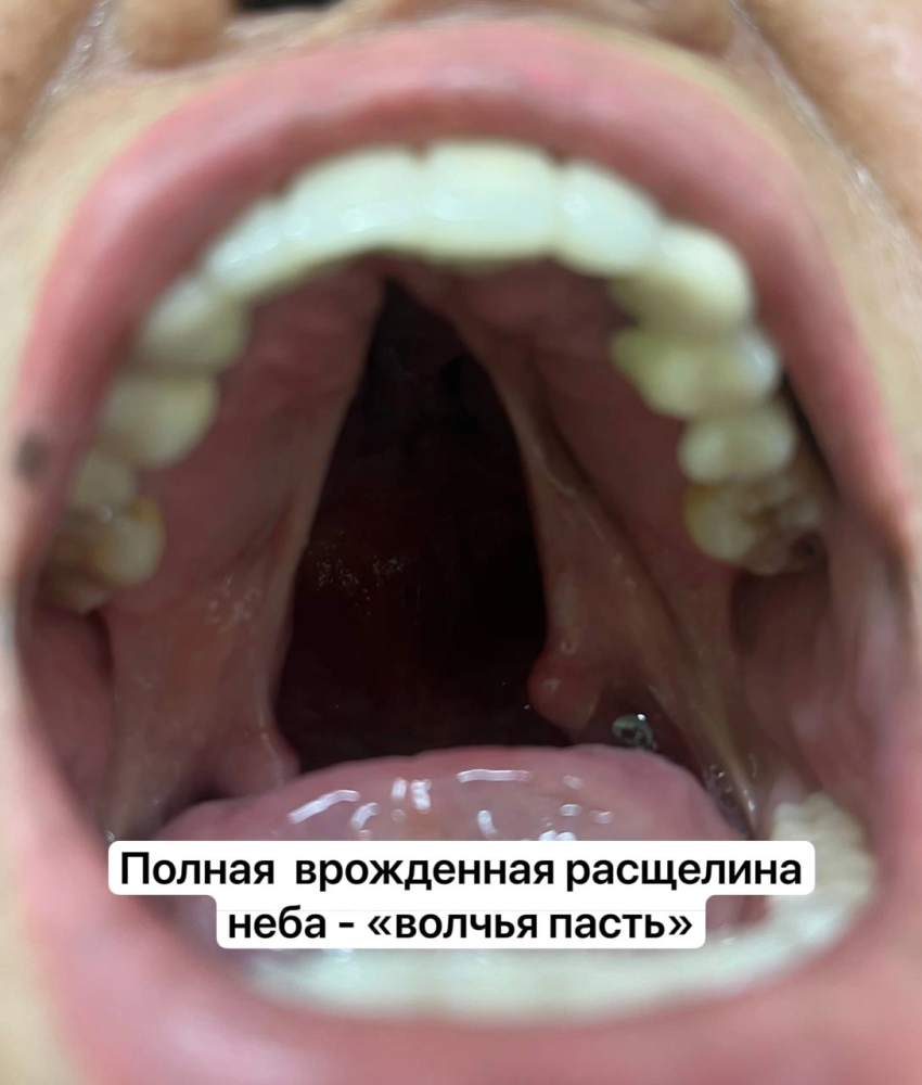    Сургутские врачи впервые в Югре прооперировали пациентку с «волчьей пастью»