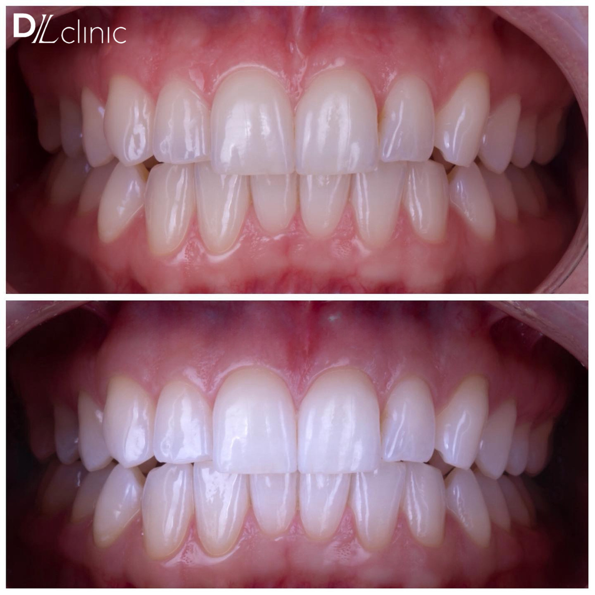 отбеливание зубов Opalescence