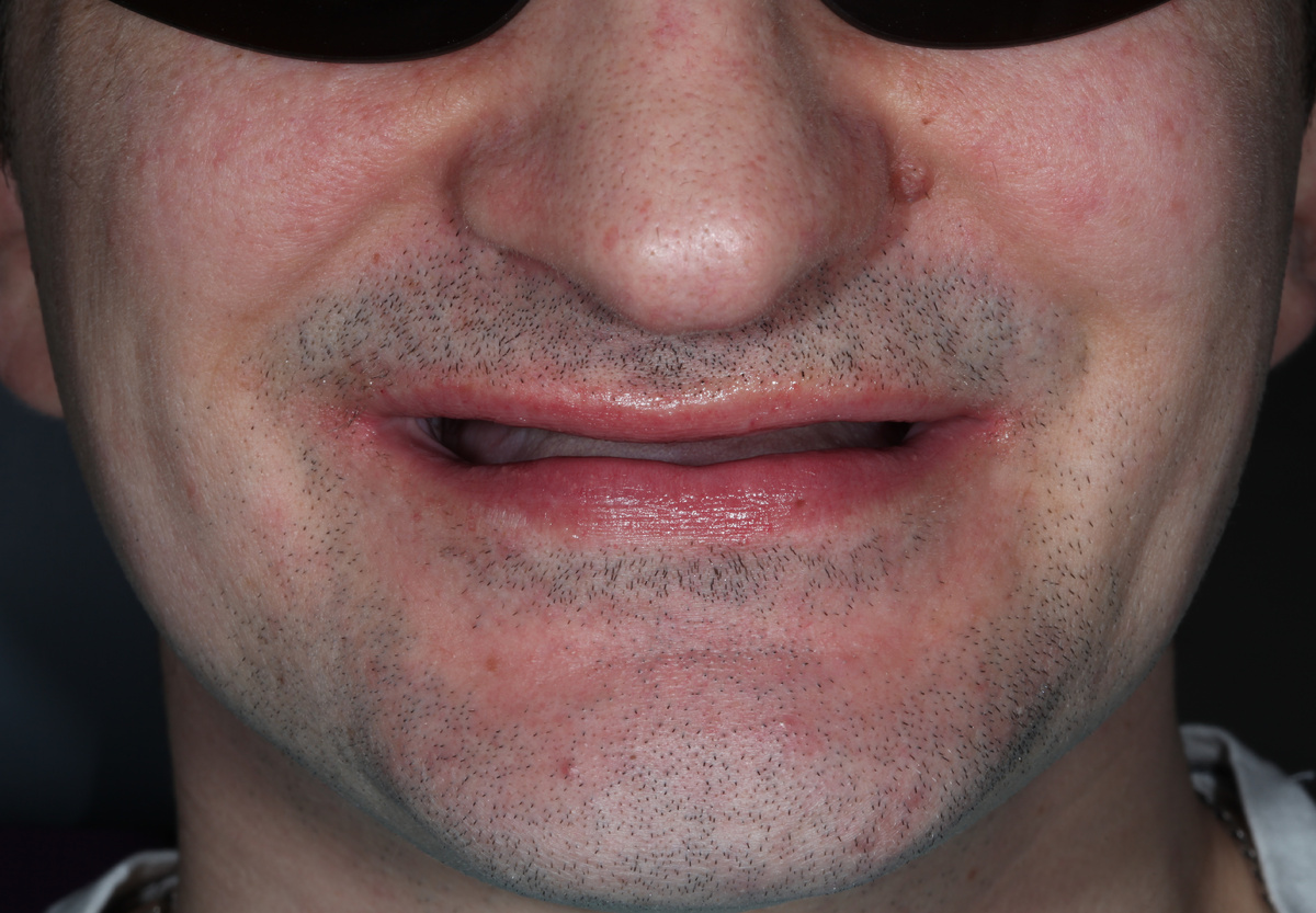 Пустота в полости рта добавляет лет жизни