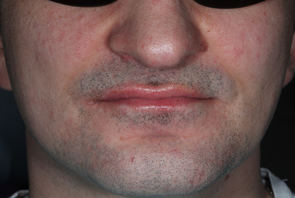 Выраженная подбородочная складка