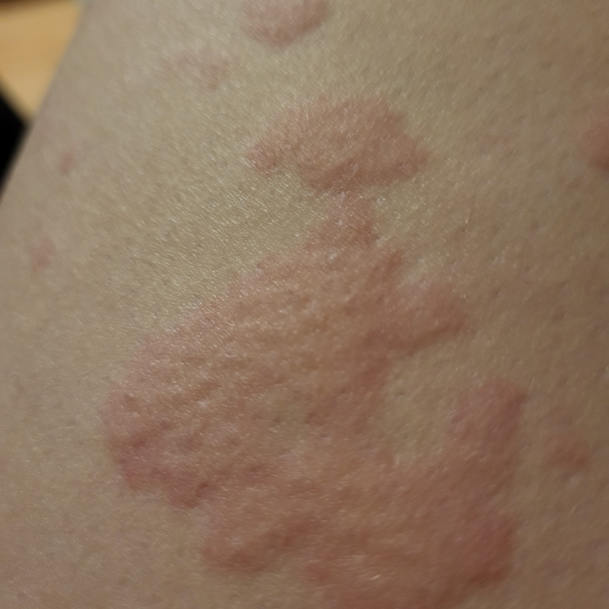 Крапивница, крупным планом