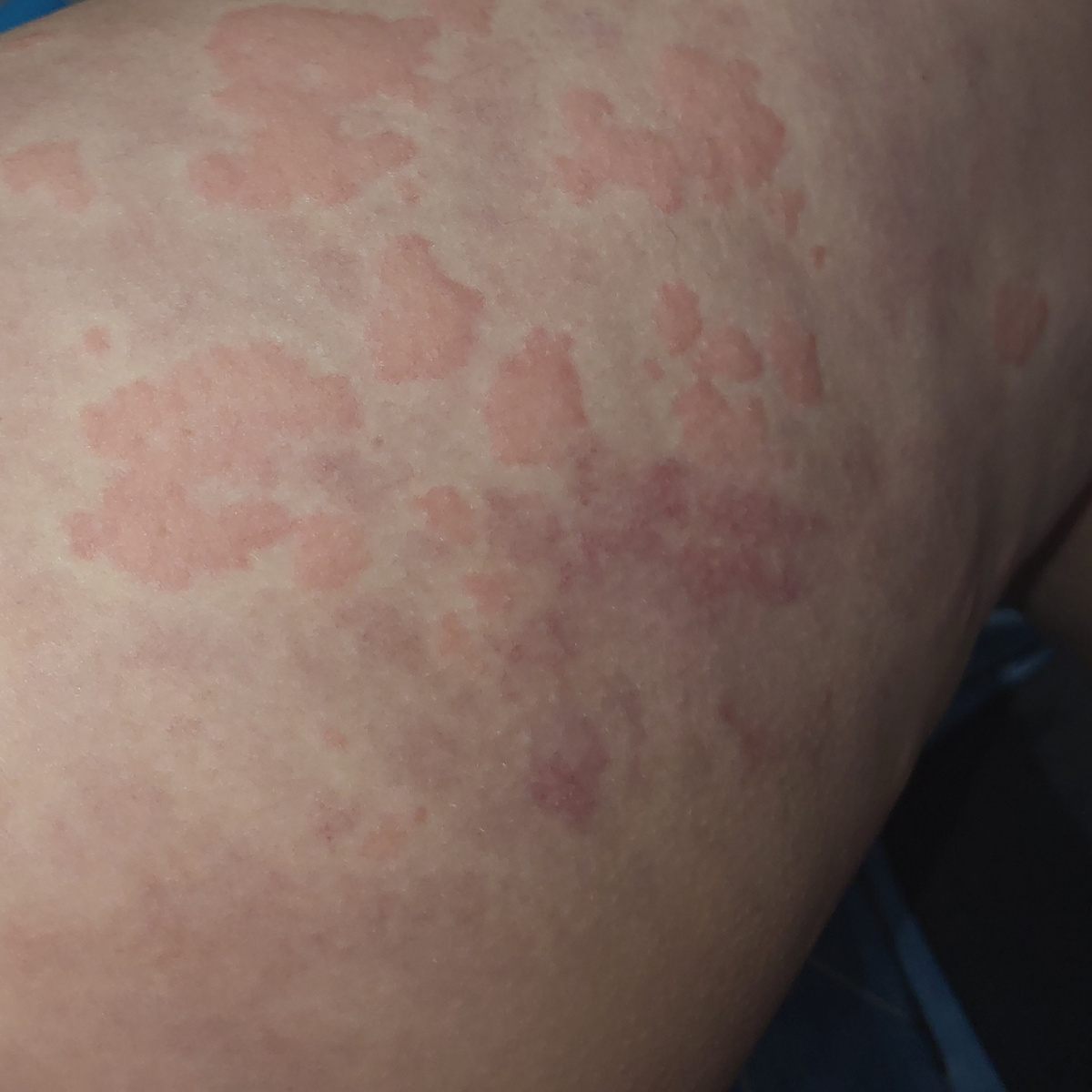 Крапивница и последствия на коже