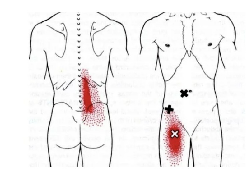 Триггерные точки подвздошно поясничной мышцы.