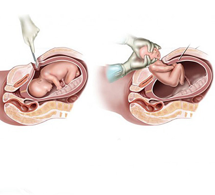 Рис.1. Извлечение ребенка при КС: тяга за головку. Картинка взята из интернета.