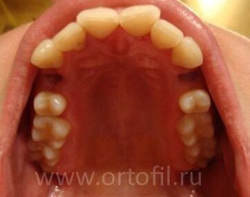 Удалённые первые премоляры ("четвёрки") при ортодонтическом лечении.