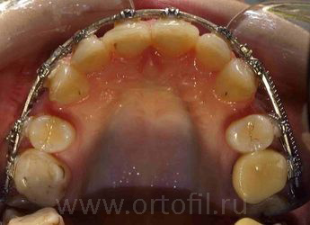 Удалённые премоляры при  неудачной попытке лечения дистальной окклюзии "только брекетами".