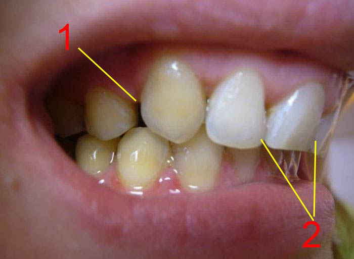 Остаточная щель (1), которую закрыть не представляется возможным, потому как наклонять резцы (2) более некуда...