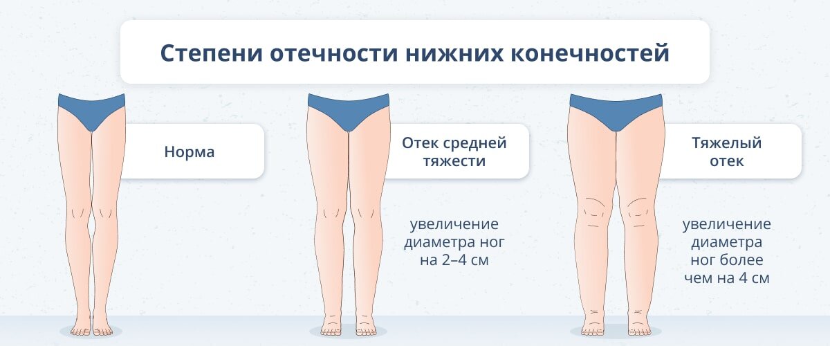 Степени отечности нижних конечностей