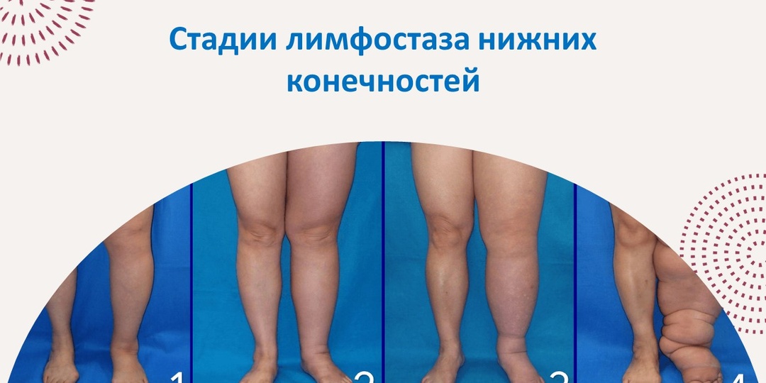 Отеки ног: с чем это связано и как избавиться