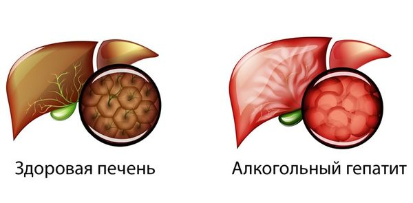 Алкогольный гепатит: Понимание и последствия