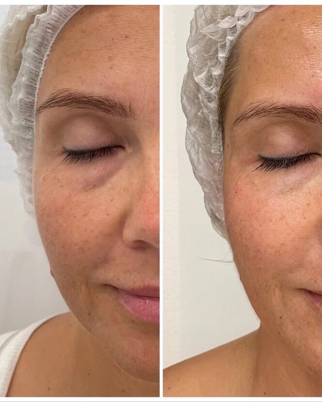 Как убрать синяки под глазами. Косметология в СПБ