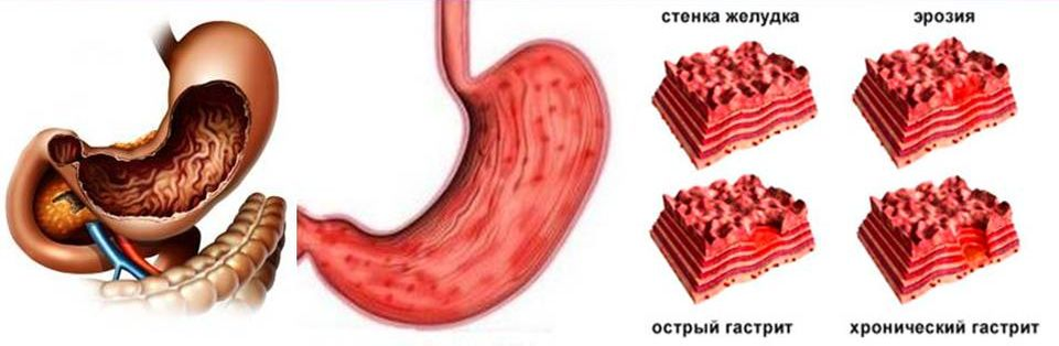 Острый и хронический гастрит