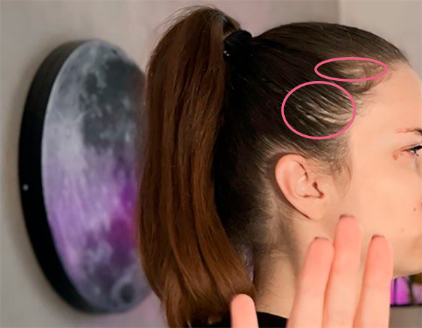 Работала с этими зонами, которые начинают редеть посезонно, если я перестаю пользоваться активаторами роста волос и лазером