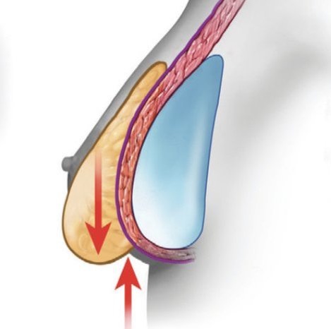 эффект водопада после увеличения груди