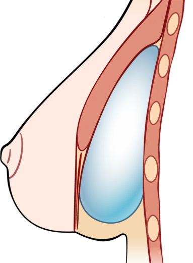 эффект дабл-бабл после маммопластики