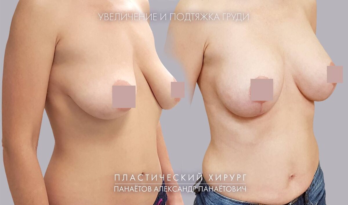 Результаты операции по увелицению и подтяжке груди
