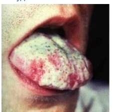 Налёт на языке при обострении язвенной болезни желудка