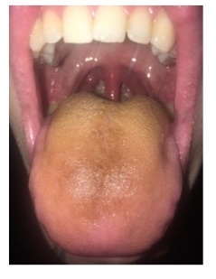 Налёт на языке при желчнокаменной болезни