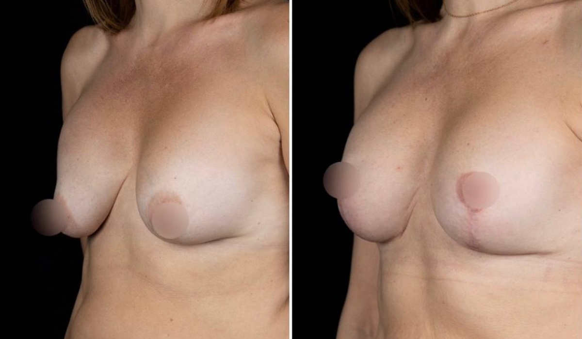 Замена имплантов с якорной подтяжкой груди. Круглые импланты Mentor 300 cc.