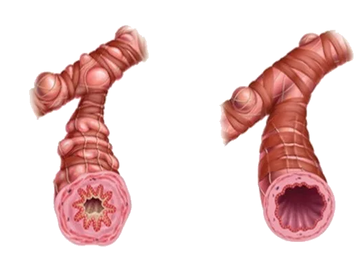 ХОБЛ. Нормальный бронх справа и при обструкции слева.