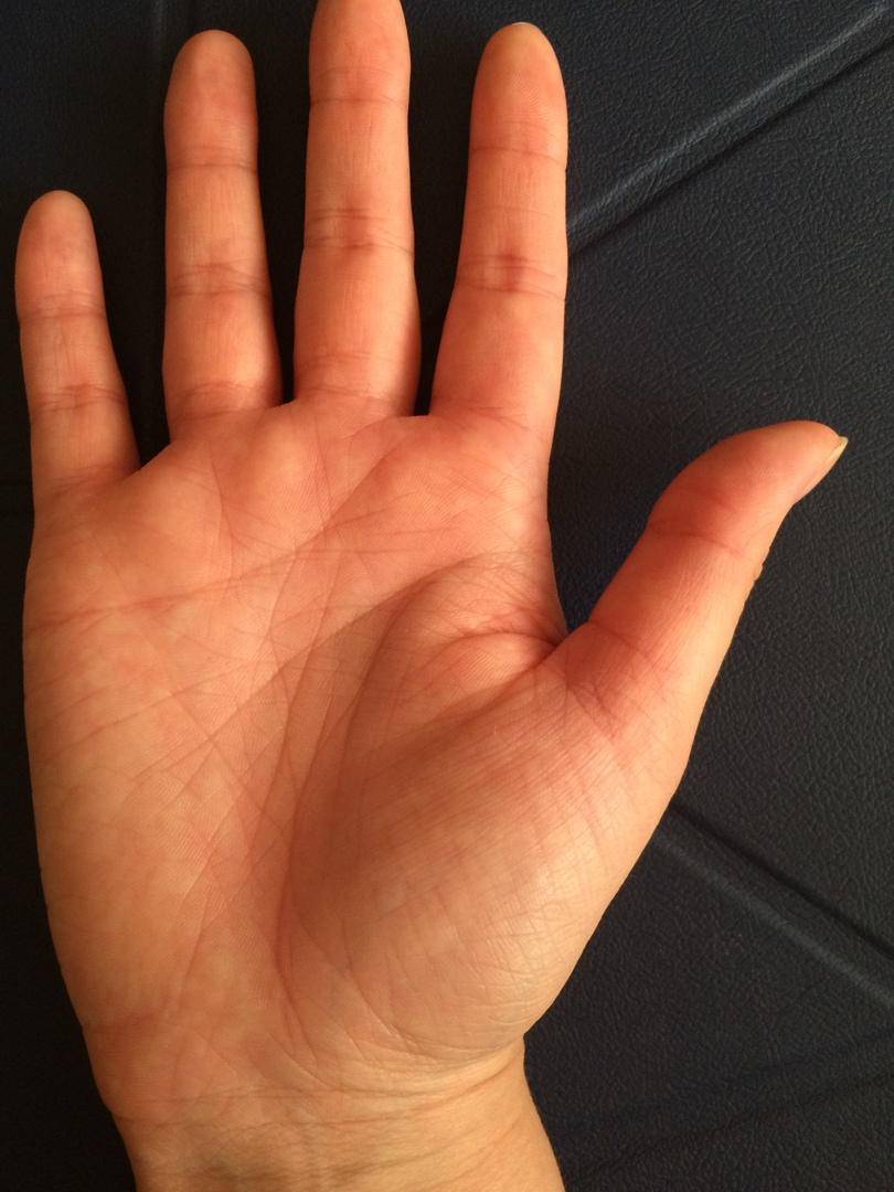 Разрыв линии жизни. Фото из личного архива.