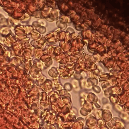 "Монетные столбики" закупоривают капилляры. Ухудшается транспорт кислорода.