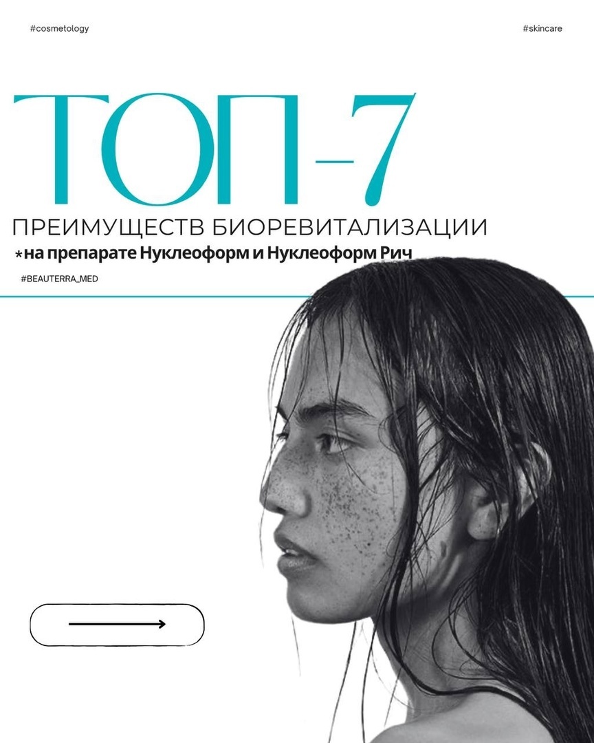 ТОП-7 преимуществ биоревитализации на препарате Нуклеоформ и Нуклеоформ Рич в клинике БЬЮТЕРРА