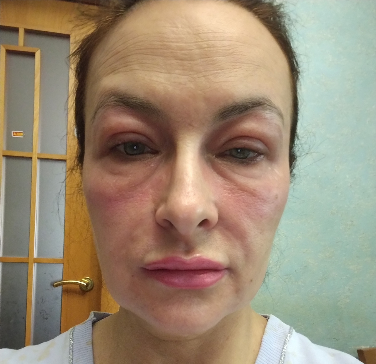 Такая я вернулась домой после процедуры. Вокруг глаз печёт, но я спасалась наложением на глаза ватных дисков, смоченных Хлоргексидином, а также через каждый час смызывала веки Бипантеном