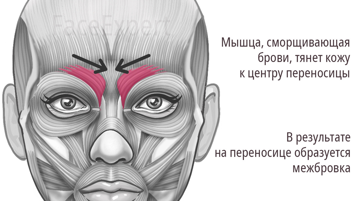 Перенапряжение мышцы, сморщивающей брови. Образование межбровки.
