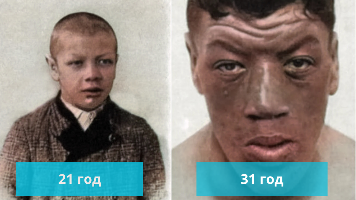 Карлик, который заболел гигантизмом. Трагическая история Адама Райнера