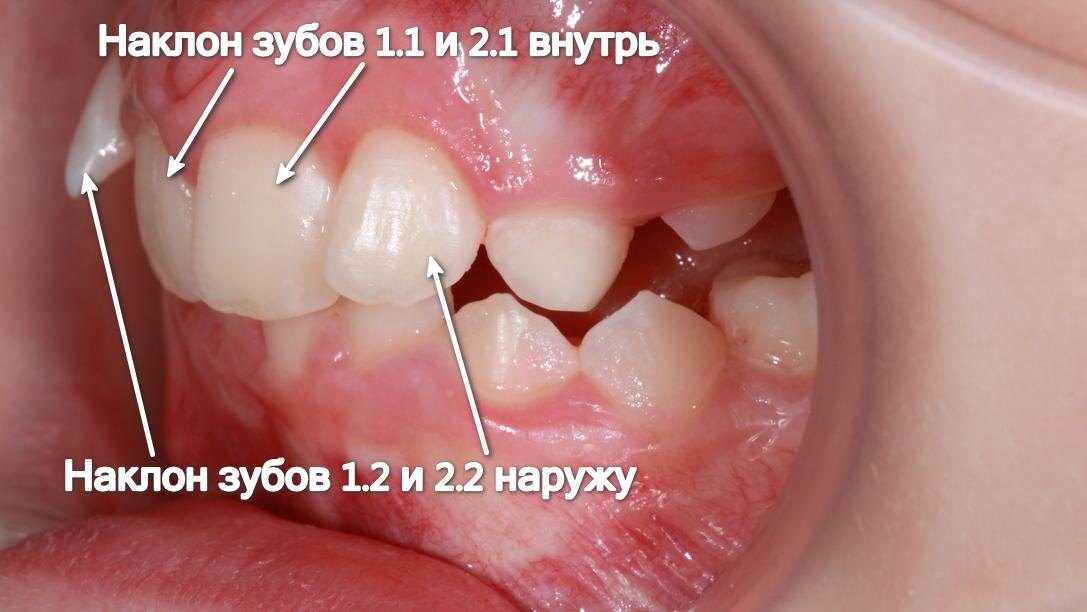 Неправильный наклон зубов 1.2-2.2