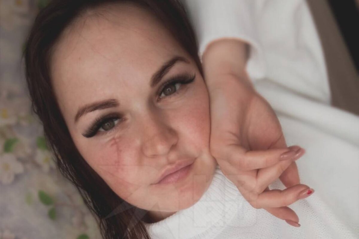 Елизавета не могла скрыть шрам, который оставил Алексей Фото: соцсети