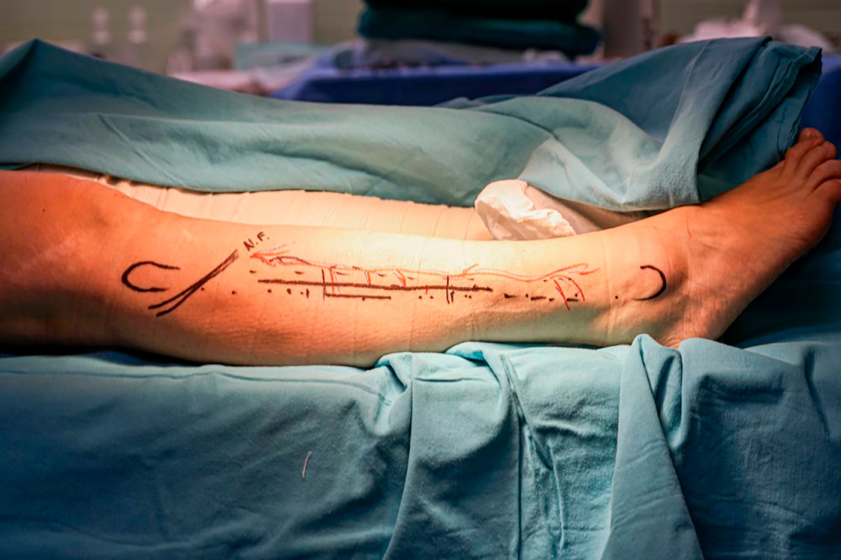 Краевая клиническая больница📷Костный аутоимплантат сформировали из малоберцовой кости женщины