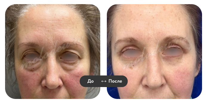 Результаты после круговой блефаропластики